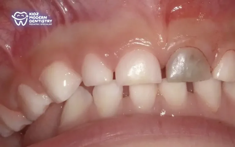 When a Tooth Turns Gray After Trauma… What Does It Mean?