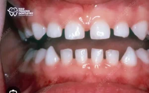 Should I Worry If My Child Has Gaps Between Their Baby Teeth?